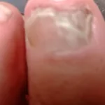 Kit complet ClearNail™ photo review