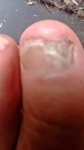 Click to view full screen Kit complet ClearNail™ photo review